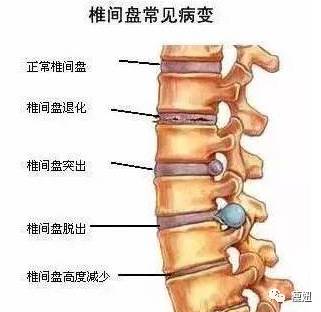 1個動作緩解腰背疼痛,還能預防腰間盤突出,頸椎病!看了絕對不後悔